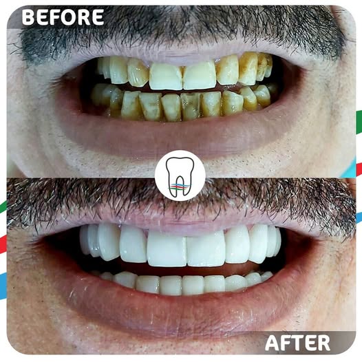 Before and After Dental Treatment 2