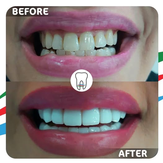Before and After Dental Treatment 3