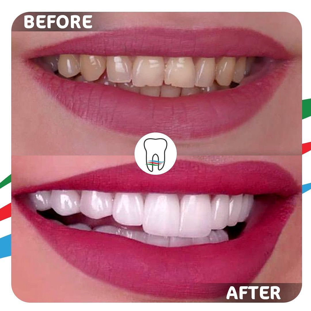 Before and After Dental Treatment 4