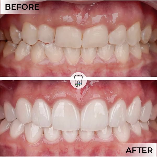 Before and After Dental Treatment 1